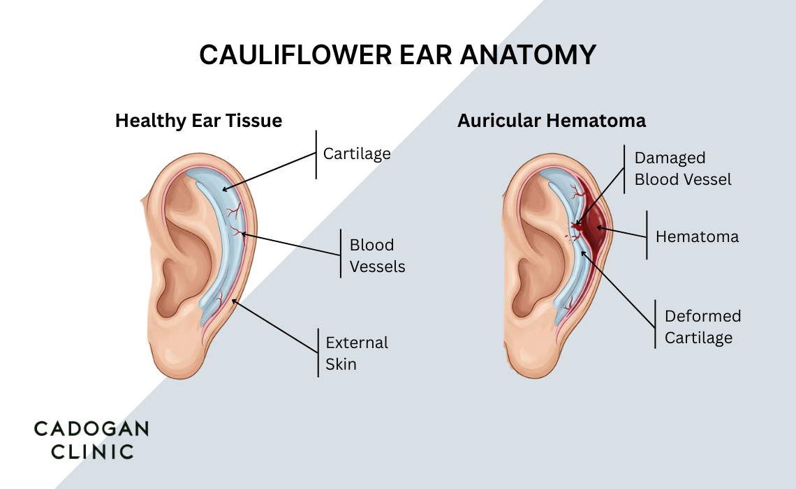 Infographic showing the formation of a hematoma in the upper ear, which leads to the development of a cauliflower ear, requiring treatment offered at Cadogan Clinic, Chelsea, London